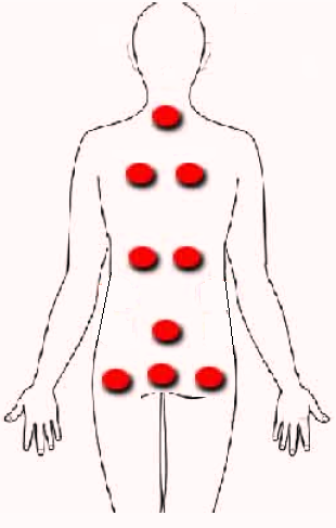 Hijamah for Pilonidal Cyst